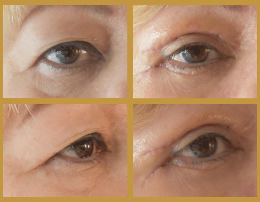 blefaroplastie