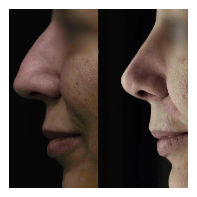 Recuperarea după rinoplastie