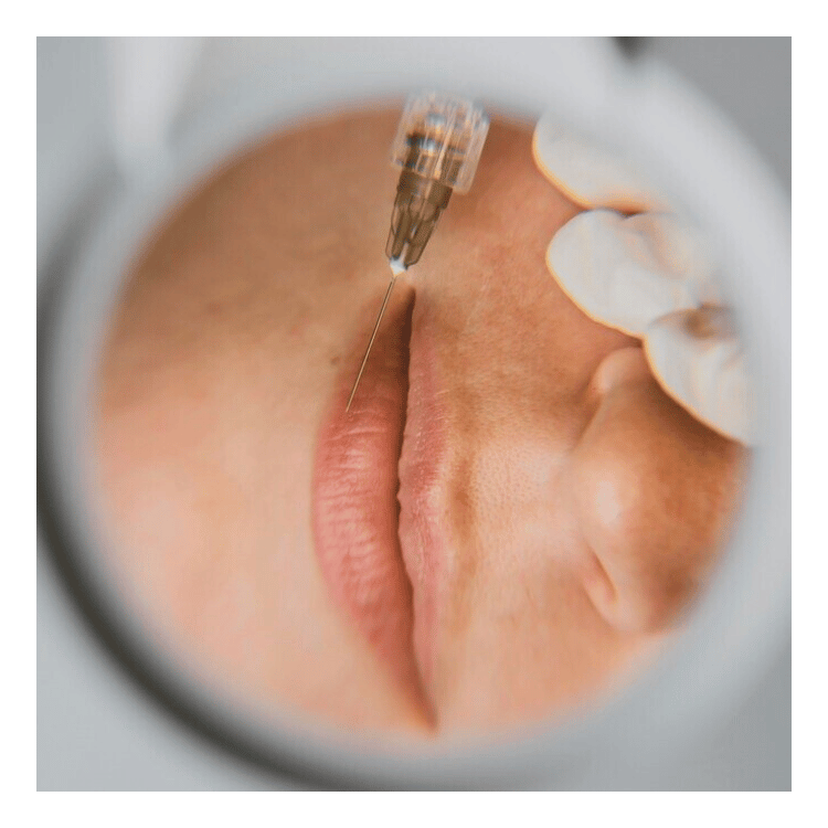 Injectie cu acid hialuronic și toxina botulinica la Soma Clinic