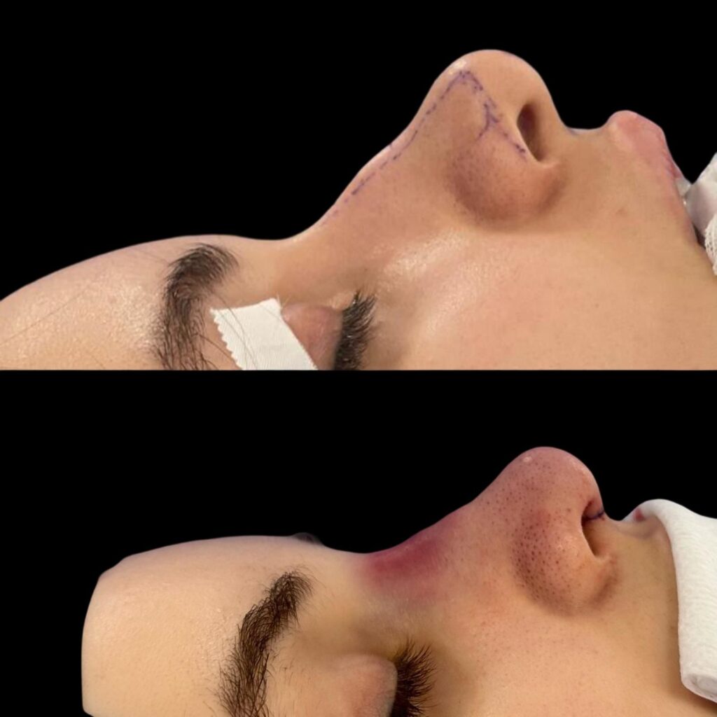 Corectie-nas-borcanat-prin-rinoplastie.-Inainte-si-dupa.