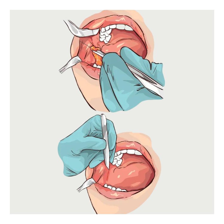 Ilustratie-in-care-un-medic-indeparteaza-bula-lui-Bichat