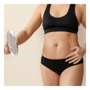 Pacienta care se pregateste pentru operatia de abdominoplastie