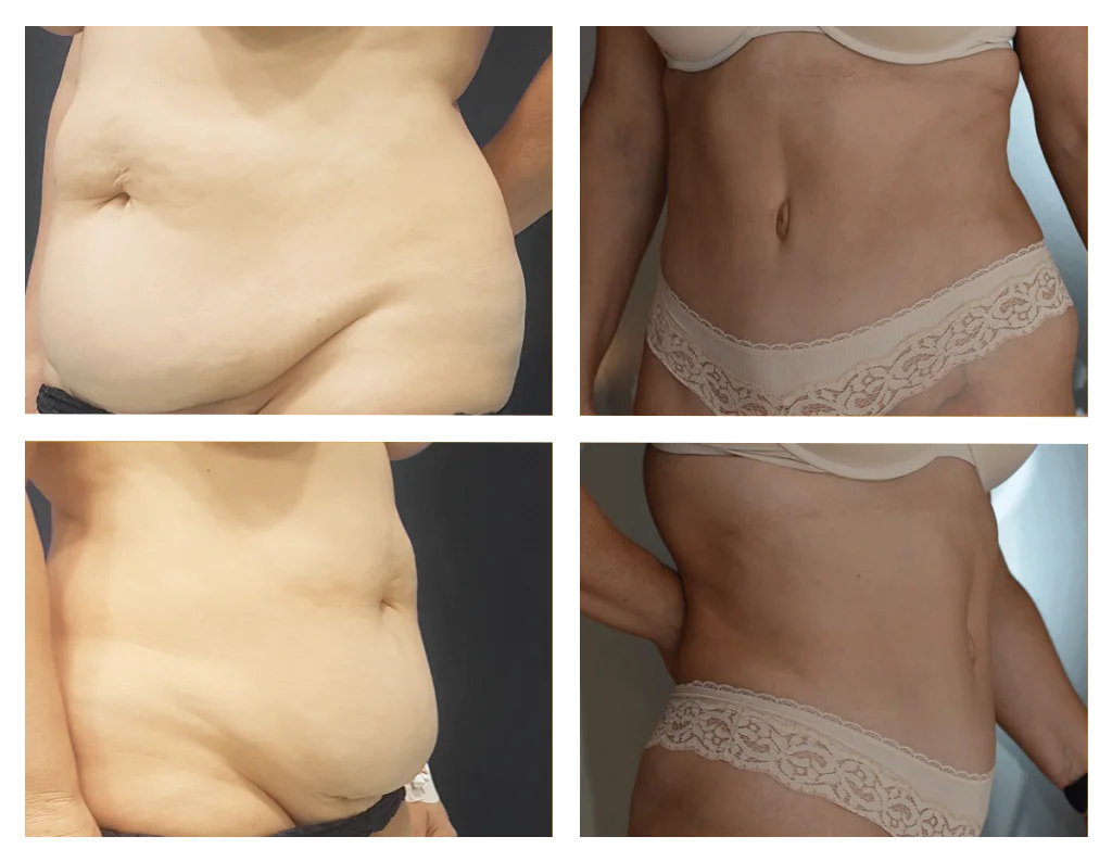 rezultate-inainte-si-dupa-operatia-de-abdominoplastie-efectuata-la-soma-clinic