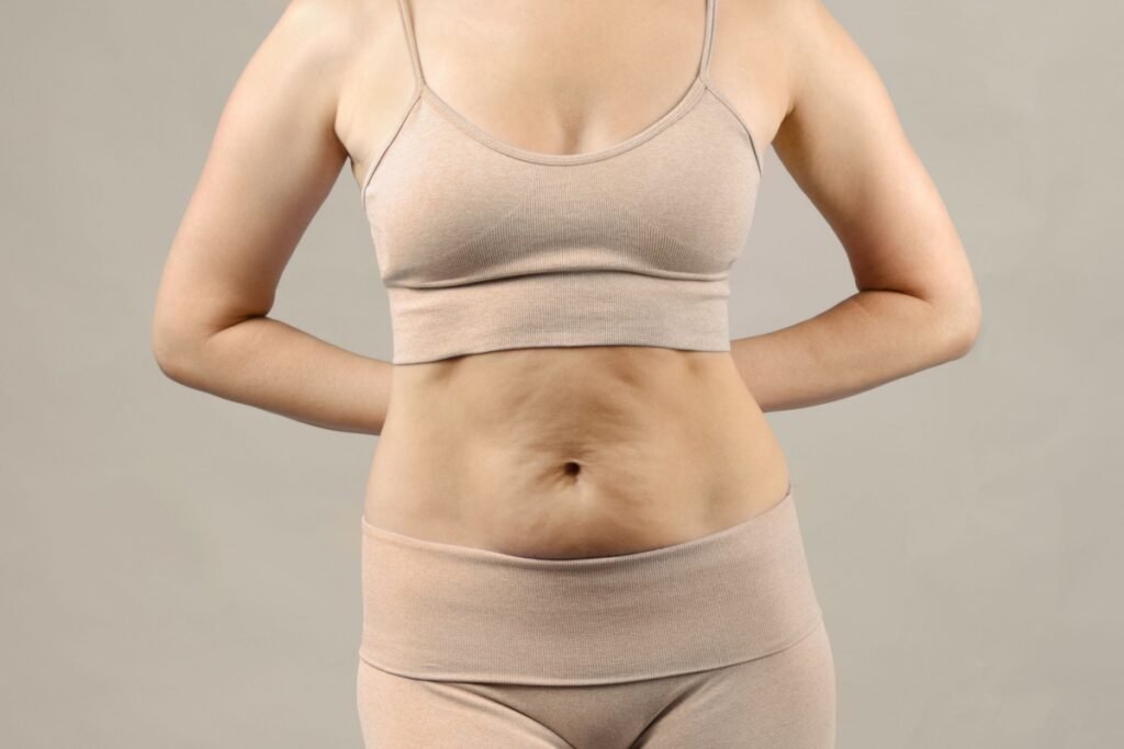 femeie cu piele laxa pe abdomen, candidat ideal pentru abdominoplastie