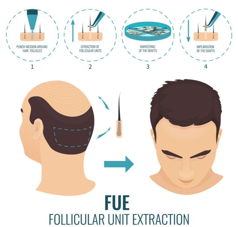 implant de par - metoda FUE